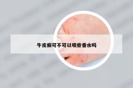 牛皮癣可不可以喷些香水吗