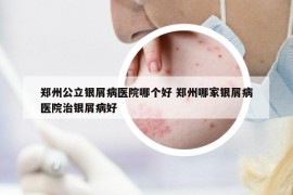 郑州公立银屑病医院哪个好 郑州哪家银屑病医院治银屑病好