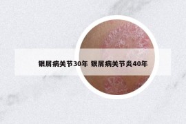 银屑病关节30年 银屑病关节炎40年