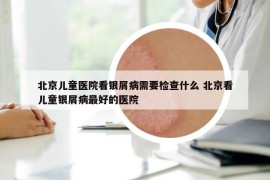 北京儿童医院看银屑病需要检查什么 北京看儿童银屑病最好的医院
