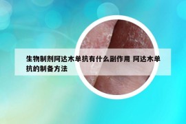 生物制剂阿达木单抗有什么副作用 阿达木单抗的制备方法