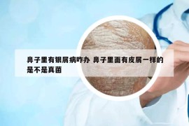 鼻子里有银屑病咋办 鼻子里面有皮屑一样的是不是真菌