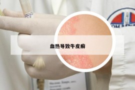 血热导致牛皮癣