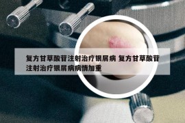 复方甘草酸苷注射治疗银屑病 复方甘草酸苷注射治疗银屑病病情加重