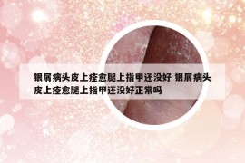 银屑病头皮上痊愈腿上指甲还没好 银屑病头皮上痊愈腿上指甲还没好正常吗