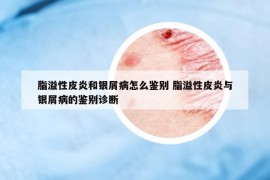 脂溢性皮炎和银屑病怎么鉴别 脂溢性皮炎与银屑病的鉴别诊断