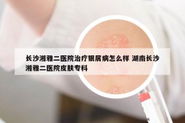长沙湘雅二医院治疗银屑病怎么样 湖南长沙湘雅二医院皮肤专科