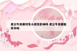 老公牛皮癣对生小孩生影响吗 老公牛皮廨能怀孕吗