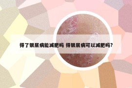 得了银屑病能减肥吗 得银屑病可以减肥吗?