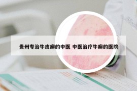 贵州专治牛皮癣的中医 中医治疗牛癣的医院