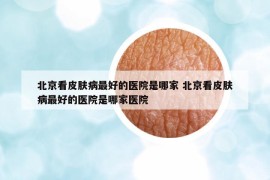 北京看皮肤病最好的医院是哪家 北京看皮肤病最好的医院是哪家医院