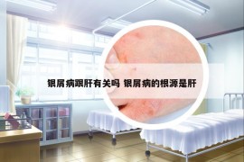 银屑病跟肝有关吗 银屑病的根源是肝