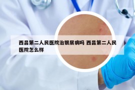 西昌第二人民医院治银屑病吗 西昌第二人民医院怎么样