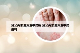 蒲公英水泡澡治牛皮癣 蒲公英水泡澡治牛皮癣吗