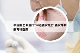 牛皮癣怎么治疗tui选西安北方 西安牛皮癣专科医院
