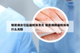 银屑病会引起扁桃体发炎 银屑病跟扁桃体有什么关联