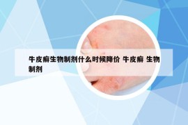 牛皮癣生物制剂什么时候降价 牛皮癣 生物制剂
