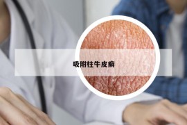 吸附柱牛皮癣