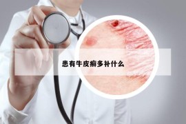 患有牛皮癣多补什么