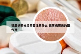 银屑病照光后需要注意什么 银屑病照光的副作用