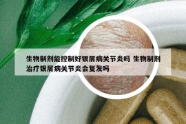生物制剂能控制好银屑病关节炎吗 生物制剂治疗银屑病关节炎会复发吗
