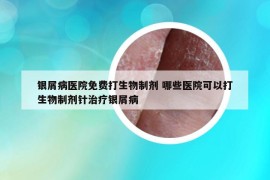 银屑病医院免费打生物制剂 哪些医院可以打生物制剂针治疗银屑病
