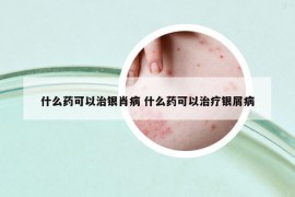 什么药可以治银肖病 什么药可以治疗银屑病