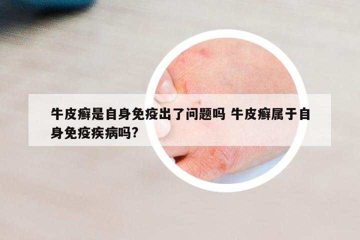 牛皮癣是自身免疫出了问题吗 牛皮癣属于自身免疫疾病吗?