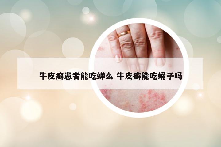 牛皮癣患者能吃蝉么 牛皮癣能吃蛹子吗