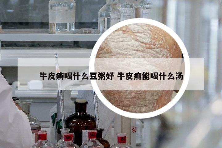 牛皮癣喝什么豆粥好 牛皮癣能喝什么汤