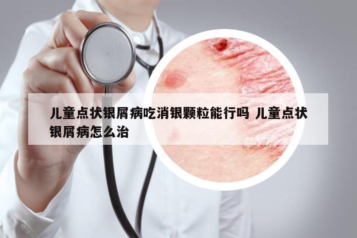 儿童点状银屑病吃消银颗粒能行吗 儿童点状银屑病怎么治