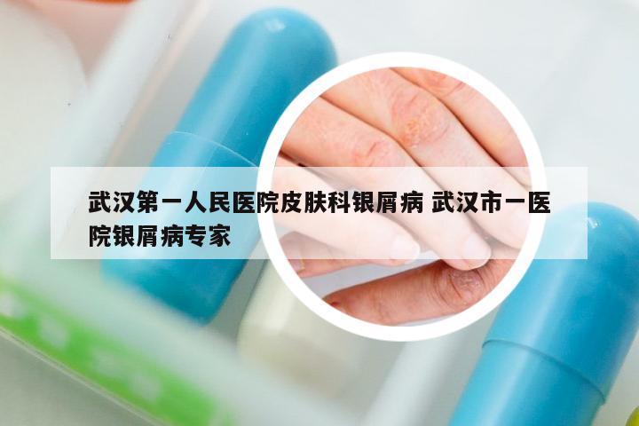 武汉第一人民医院皮肤科银屑病 武汉市一医院银屑病专家