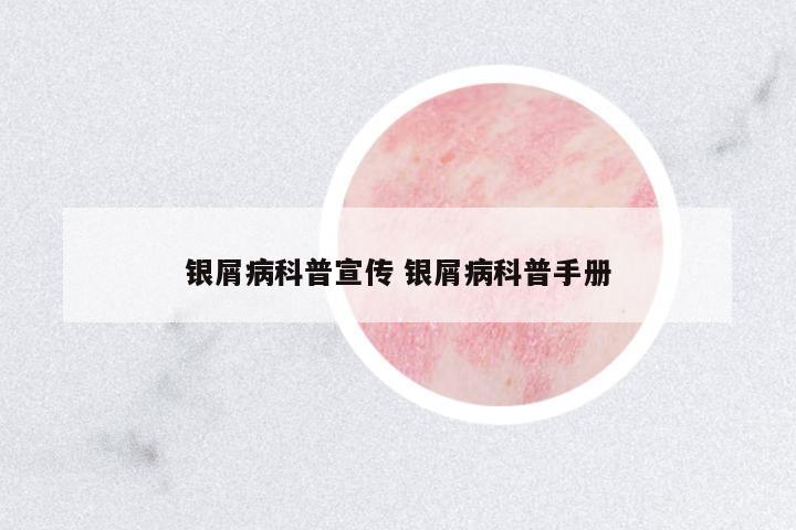 银屑病科普宣传 银屑病科普手册
