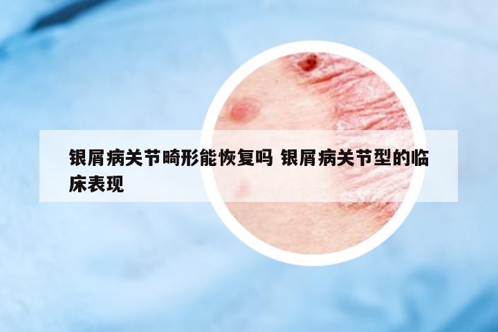 银屑病关节畸形能恢复吗 银屑病关节型的临床表现