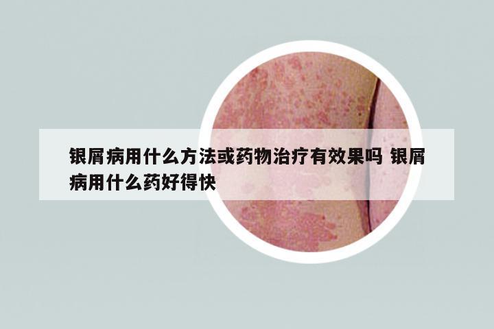 银屑病用什么方法或药物治疗有效果吗 银屑病用什么药好得快