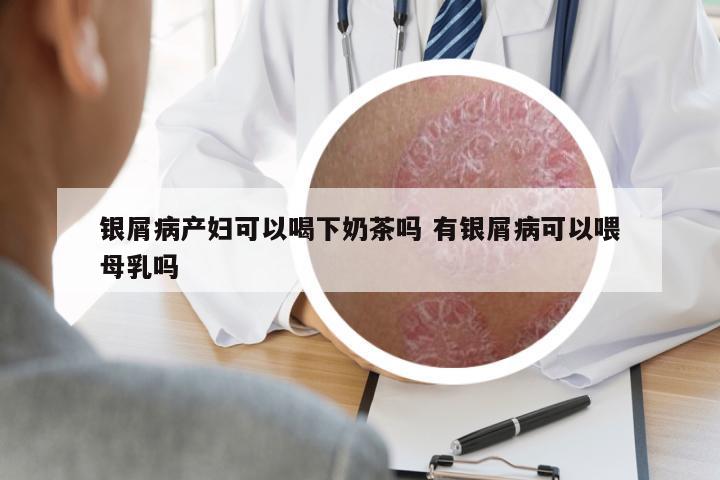 银屑病产妇可以喝下奶茶吗 有银屑病可以喂母乳吗
