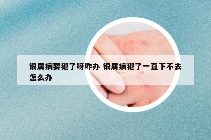 银屑病要犯了呀咋办 银屑病犯了一直下不去怎么办