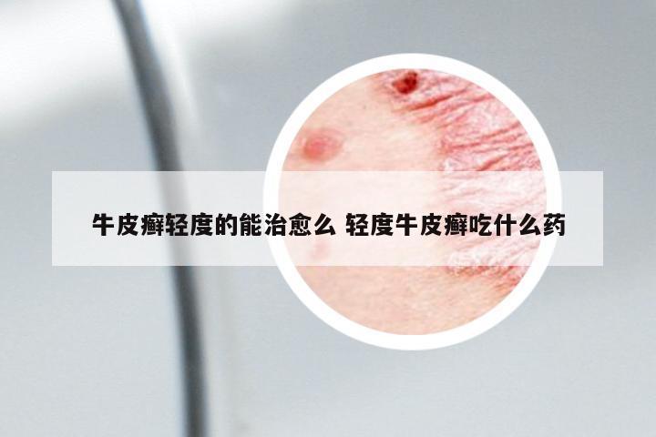 牛皮癣轻度的能治愈么 轻度牛皮癣吃什么药