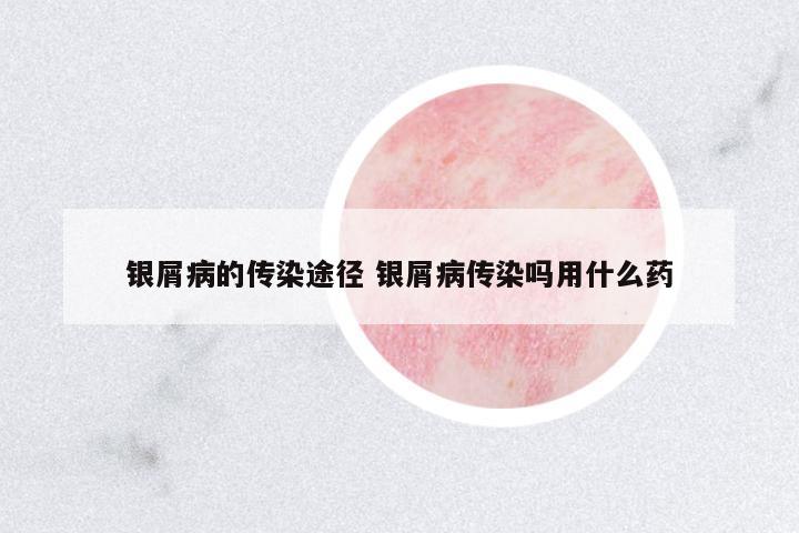 银屑病的传染途径 银屑病传染吗用什么药