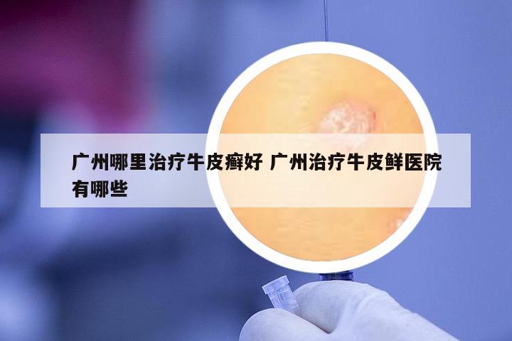广州哪里治疗牛皮癣好 广州治疗牛皮鲜医院有哪些