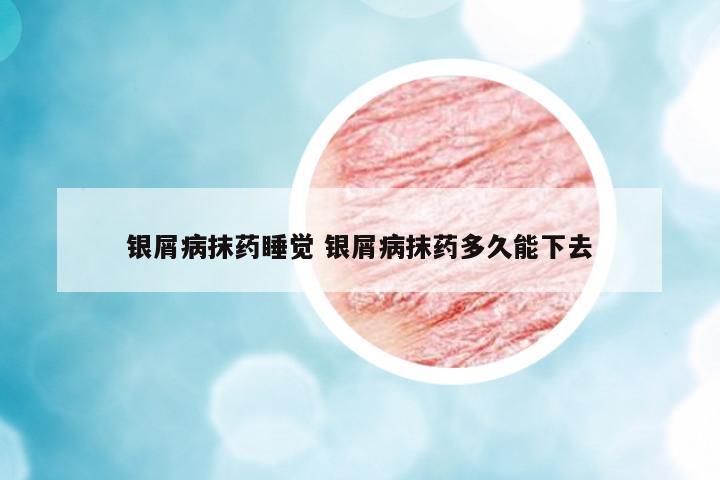 银屑病抹药睡觉 银屑病抹药多久能下去