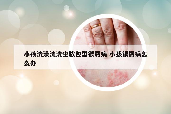 小孩洗澡洗洗尘脓包型银屑病 小孩银屑病怎么办