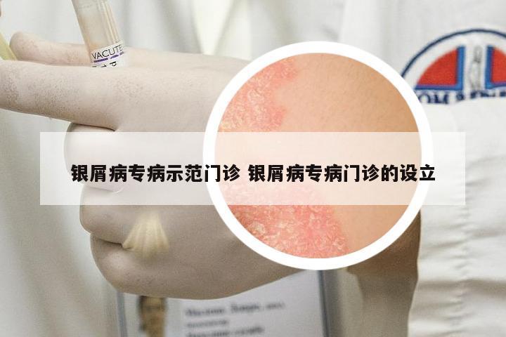 银屑病专病示范门诊 银屑病专病门诊的设立