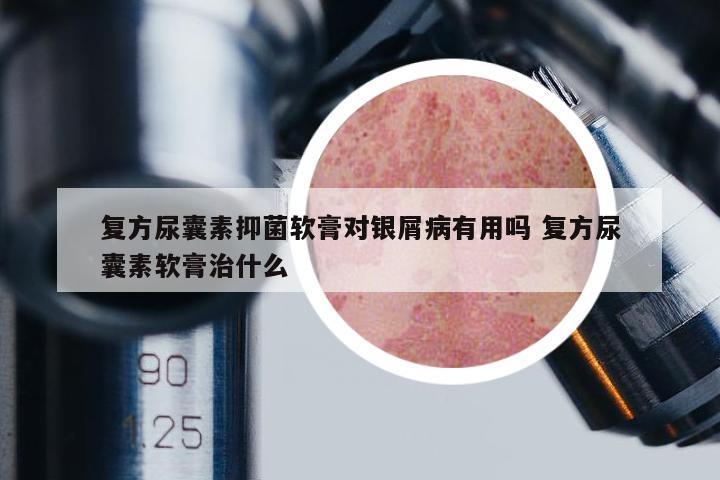 复方尿囊素抑菌软膏对银屑病有用吗 复方尿囊素软膏治什么