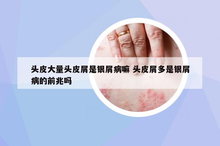 头皮大量头皮屑是银屑病嘛 头皮屑多是银屑病的前兆吗